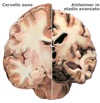 Nuove scoperte sull’Alzheimer: l’ormone ossitocina efficace contro i danni delle placche