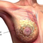 Cancro al seno novità miRNA e staminali