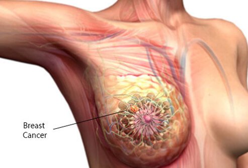 Cancro al seno: trovate molecole che fanno crescere i tumori