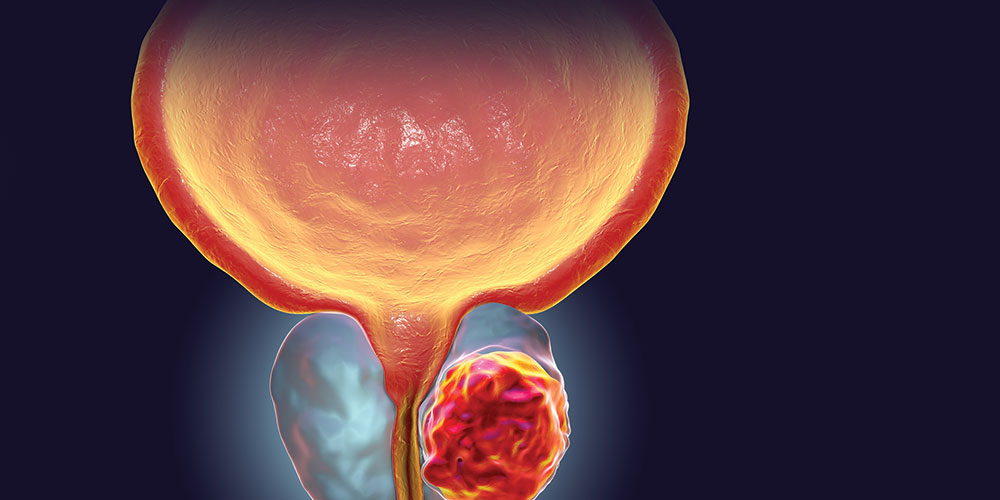 Cancro alla prostata: scoperta una proteina fondamentale per nuove cure