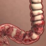 Morbo di Crohn future cure nuove con batteri buoni