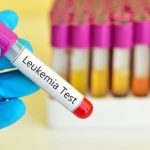 Leucemia fulminante acuta nuove cure