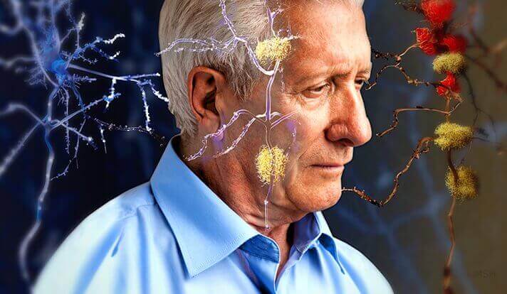 Perchè si perde la memoria con l’Alzheimer?