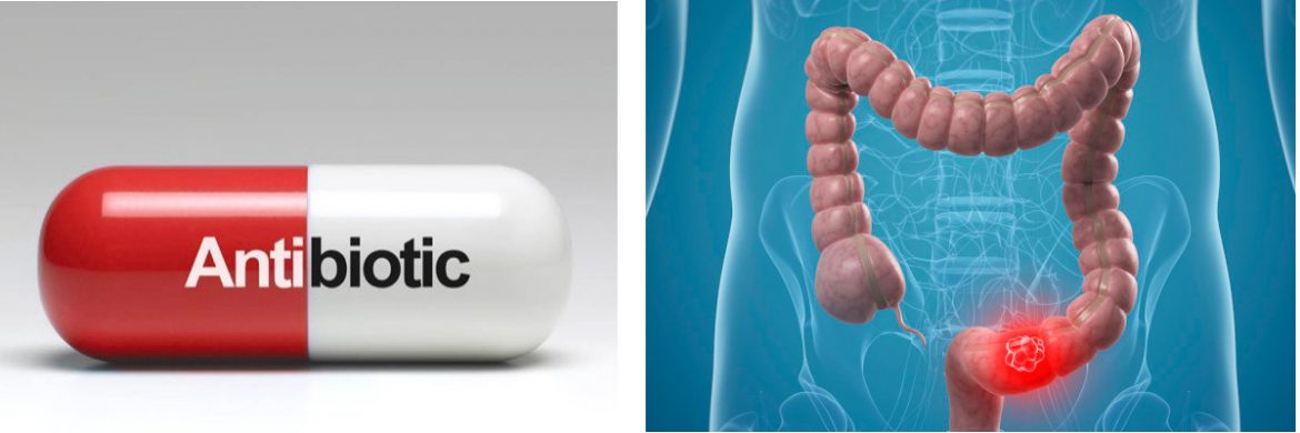 Cause del cancro al colon: nuova scoperta su ruolo degli antibiotici