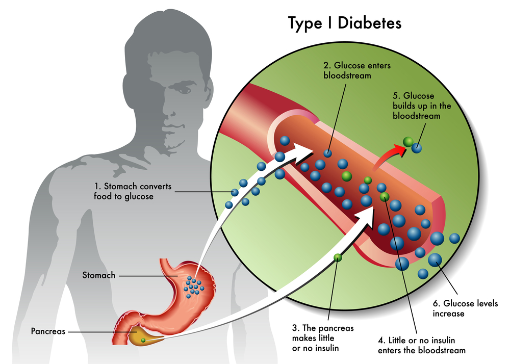 Diabete tipo 1 nuove cure con staminali: i risultati
