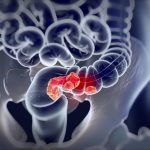 Cancro al colon ultime novità cure