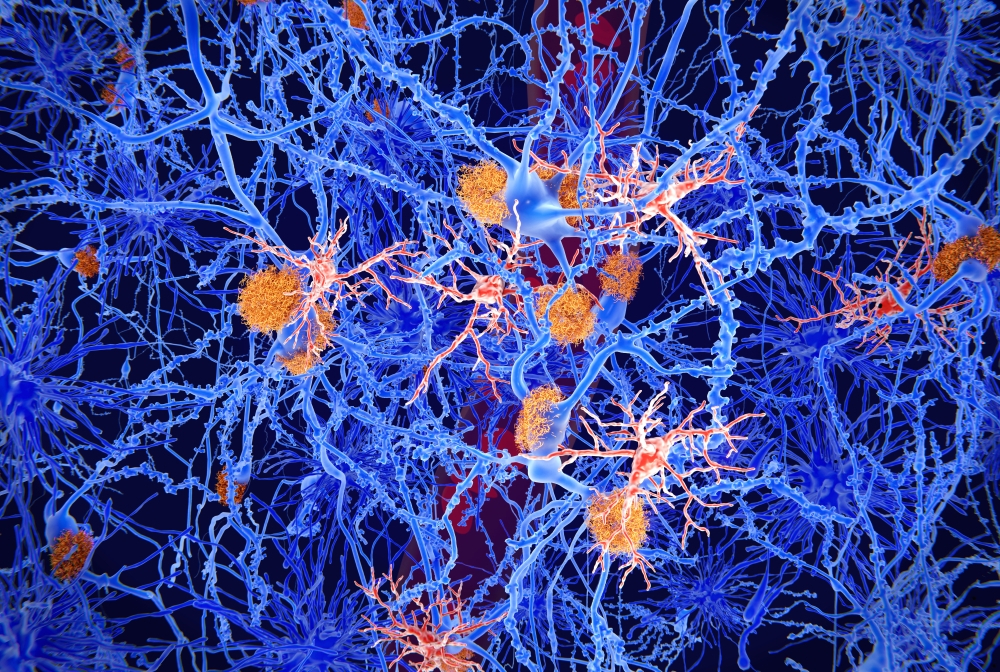 Alzheimer ultime novità: scienziati scoprono come far guarire cellule malate