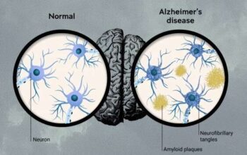 Lecanemab nuovo farmaco contro Alzheimer