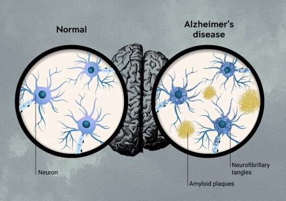 Lecanemab farmaco contro Alzheimer: risultati sperimentazione