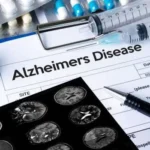 Nuovo farmaco Alzheimer 2023 Donanemab
