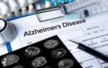 Nuovo farmaco Alzheimer 2023 Donanemab