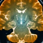 Parkinson scoperta causa della malattia batterio desulfovibrio