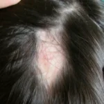 Alopecia areata nuovo farmaco per la cura