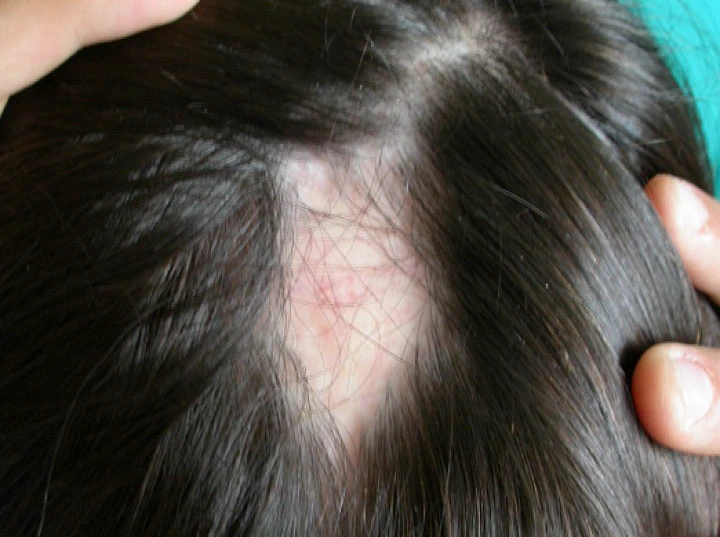 Alopecia areata approvato nuovo farmaco Ritlecitinib per la cura