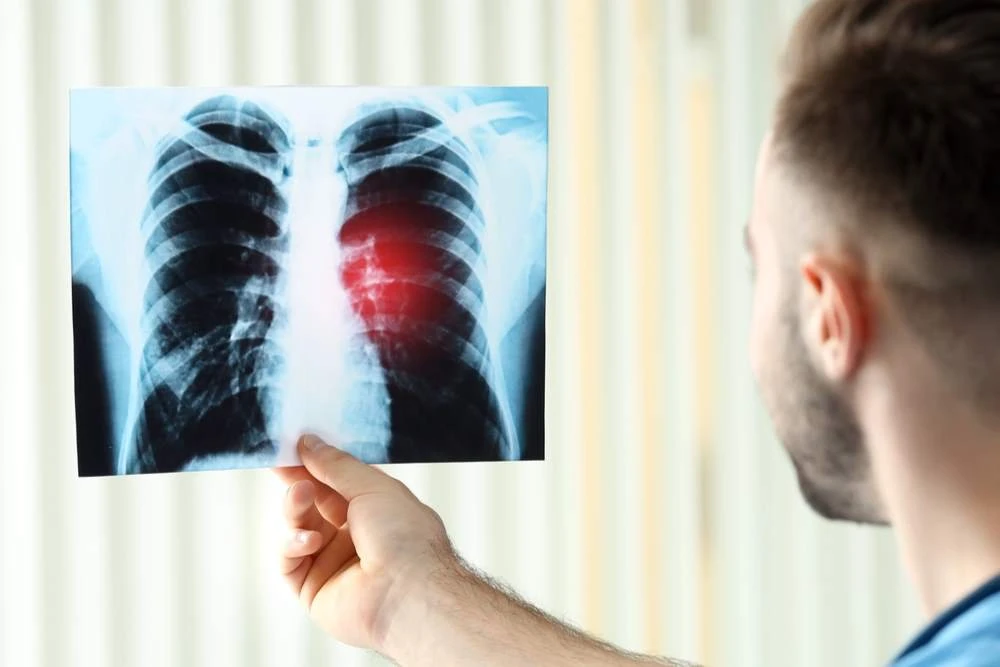 Cancro ai polmoni: nuovo farmaco Osimertinib riduce del 50% rischio di morte