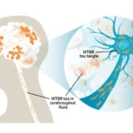 Alzheimer diagnosi nuovo marcatore proteina Tau MTBR