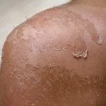 Esposizione al sole effetti nocivi sulla pelle