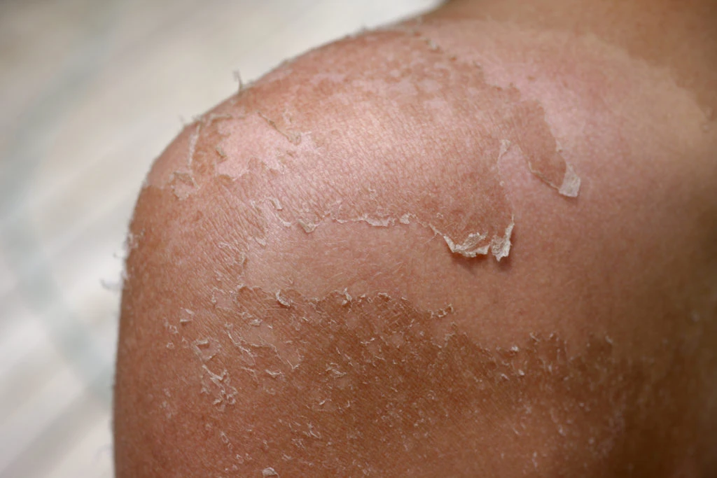 Effetti negativi del sole sulla pelle: danni al collagene e ispessimento