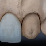 Ricrescita denti naturali negli adulti