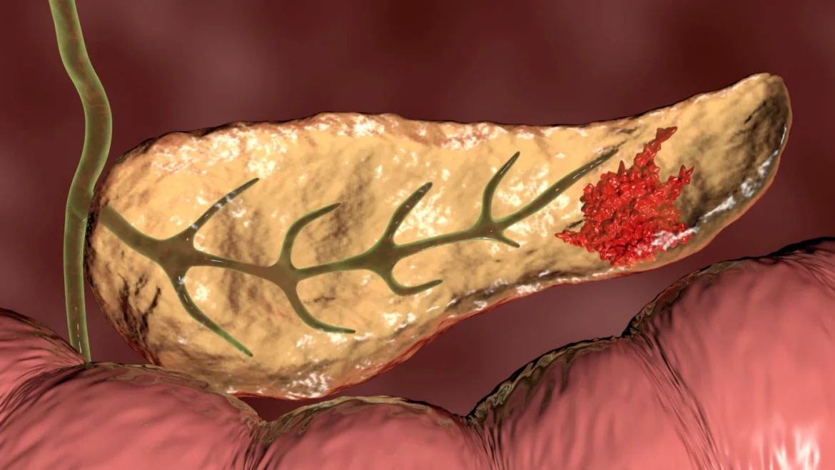 Tumore al pancreas novità: scoperta la causa che lo fa crescere IL-1beta+