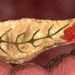 Tumore al pancreas novità 2023 scoperta causa