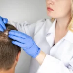 Nuovo farmaco Ritlecitinib per la cura alopecia areata