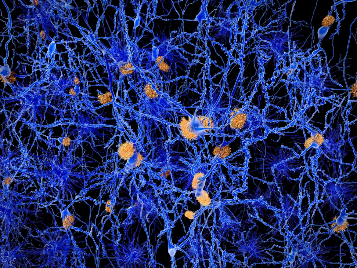 Alzheimer nuovi studi su recettore LILRB4 e microglia coinvolti nell’accumulo di proteine